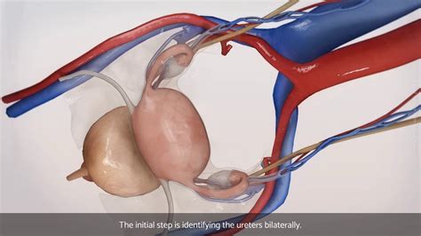 Laparoscopic bilateral salpingo-oophorectomy (BSO) - YouTube