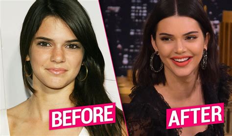 Kendall Jenner's Plastic Surgery Exposed By Top Docs