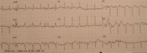 Dr. Smith's ECG Blog: Respiratory Failure, Heart Failure, and Narrow Complex Tachycardia