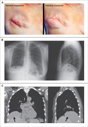 Disappearance of a Breast Prosthesis during Pilates | NEJM