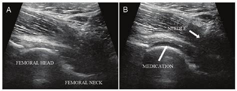 Clinical outcomes of ultrasound-guided hip joint injection in the treatment of persistent pain ...