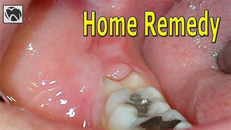 Pericoronitis Home Remedy | Best Pericoronitis Treatment at Home | Wisdom Teeth - YouTube