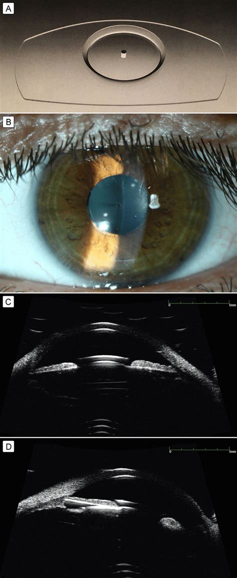 A, Posterior chamber collamer phakic intraocular lens RSK-3 (S.... | Download Scientific Diagram