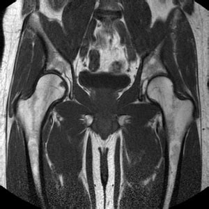 Basic-hip-mri