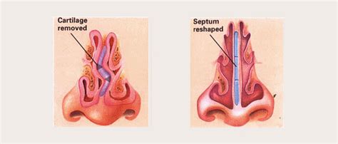 Septum Turbinates