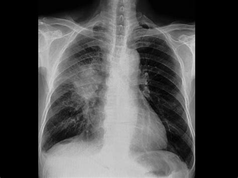 Idiopathic Pulmonary Fibrosis Prognosis Predicted by CT Parameters ...