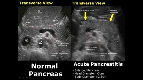 Pancreatic Pseudocyst Ultrasound