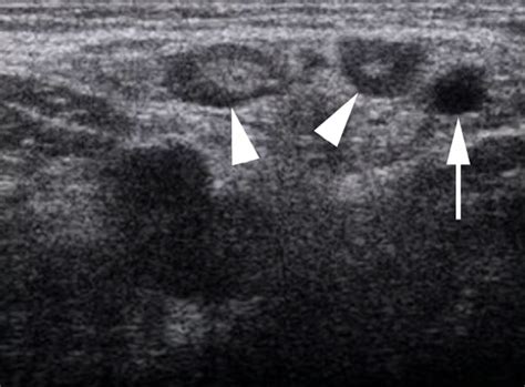 Soft Tissue Images | Emergency Ultrasonography