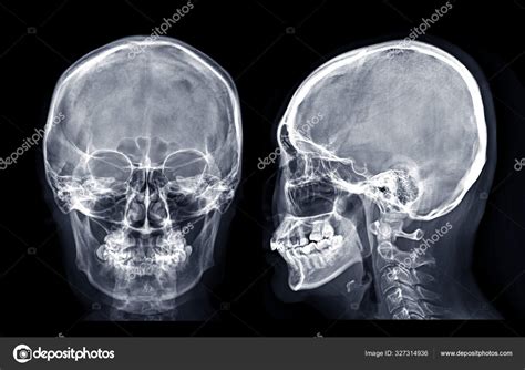 Skull Ray Image Human Skull Lateral Isolated Black Background Stock Photo by ©samunella 327314936