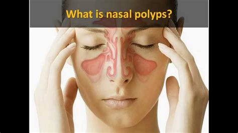 How to treat nasal polyps permanently with the Nasal Polyps Treatment ...