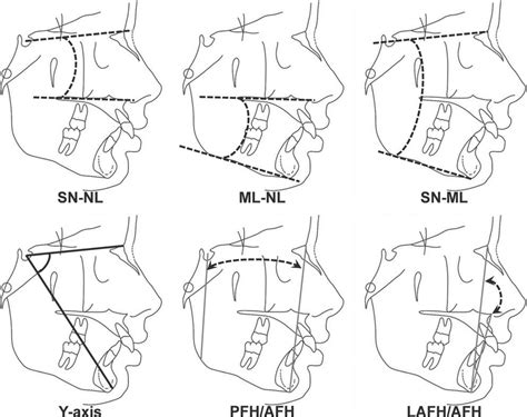 Cephalometric measurements used: A, SN-NL (sellanasion/nasal line... | Download Scientific Diagram