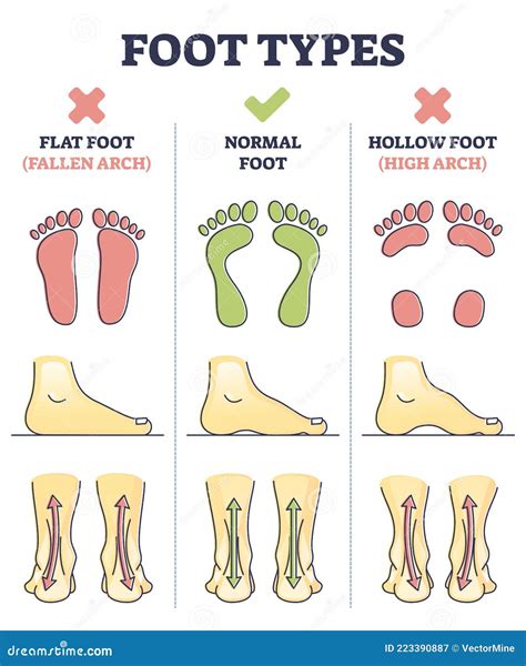 Foot Types with Flat, Normal and Hollow Feet Comparison in Outline ...