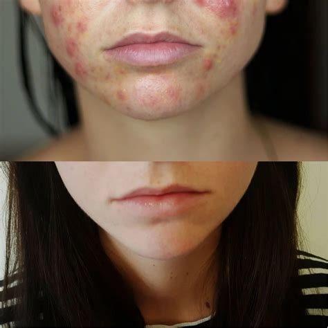 Spironolactone Clears Woman’s Acne in 4 Months: Before and After Photos ...