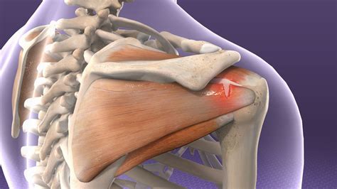 Rotator Cuff Injury - Laser Therapy in Newmarket