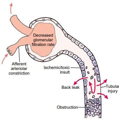 Pathogenesis of acute tubular necrosis. Sloughing and necrosis of... | Download Scientific Diagram