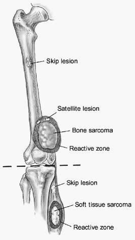 Osteogenic sarcoma Archives - PT Master Guide