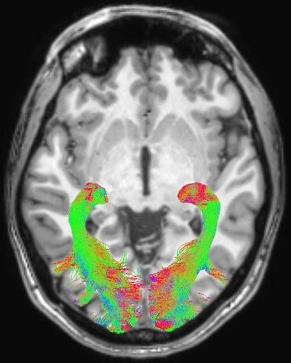 Our Parkinson's Place: Brain MRI Shows Visual System Changes in ...