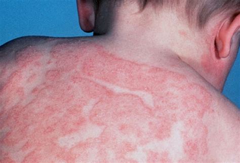 Picture of Atopic Dermatitis or Eczema