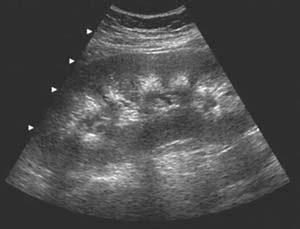 medullary sponge kidney ultrasound - Google Search | Medullary sponge kidney, Ultrasound, Renal ...