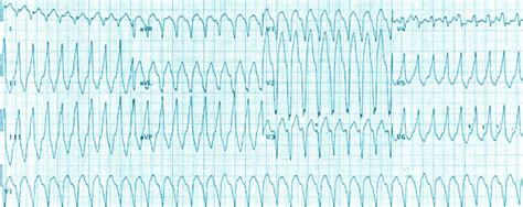 Difference Between Polymorphic and Monomorphic Ventricular Tachycardia