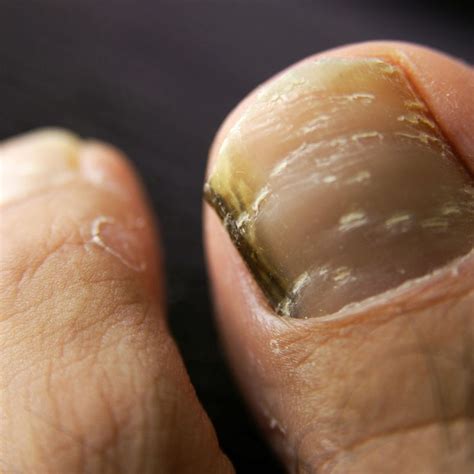 What is Black Toenail Fungus? | Forces of Nature Medicine