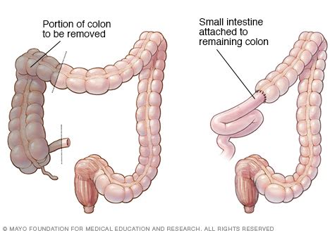 Right hemicolectomy - Mayo Clinic