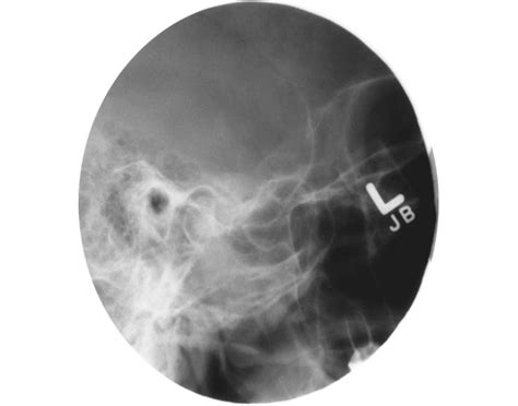 TMJ Radiograph - Axiolateral Projection (Schuller) — Printable Worksheet