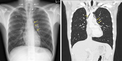 Pneumomediastinum - CXR and CT - Radiology at St. Vincent's University Hospital