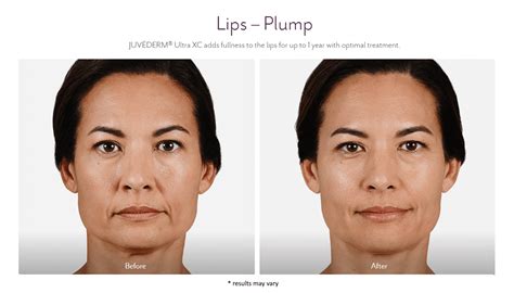 Juvederm Before and After Pictures | Juvederm Westport CT