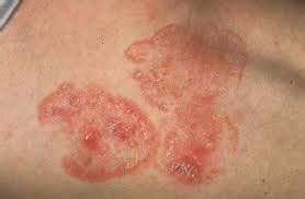 Mycosis Fungoides is a Rare Lymphoma Cancer Affecting the Skin