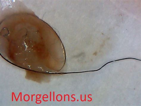 Shapes of Morgellons Disease The Silent Pandemic – fibromyalgia ...