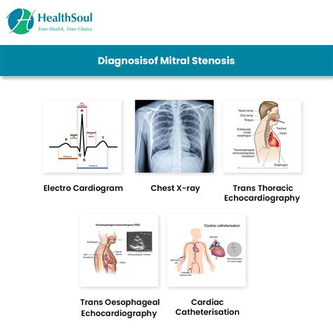 Mitral Valve Stenosis: Symptoms and Treatment | Cardiology | HealthSoul