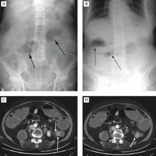 (A, B) The ascending and transverse colon of the transverse colon ...