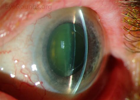 Atlas Entry - Pseudoexfoliation syndrome