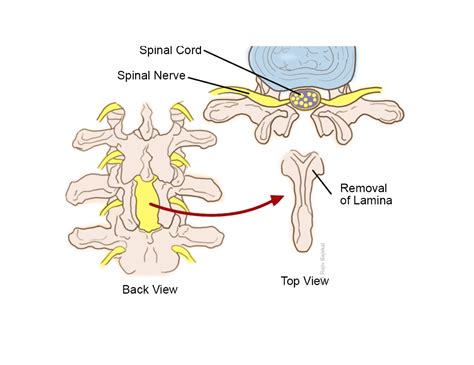 Lumbar Decompression (Laminectomy) - Rajiv Bajekal