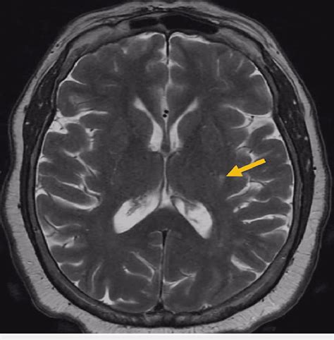 MRI of the brain showing scattered T2 hyperintensities in the... | Download Scientific Diagram