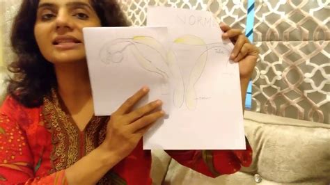 क्या आपकी बच्चेदानी प्रेगनेंसी के लिए स्वस्थ है - Unicornuate Uterus Pregnancy - YouTube