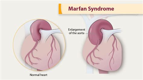 Marfan Syndrome Treatment In India - Rawa Health