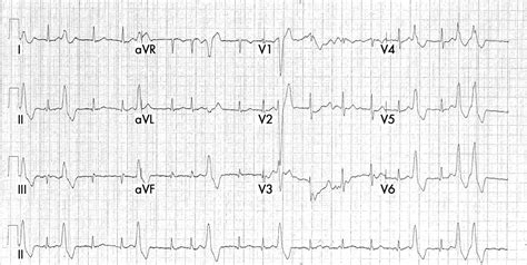 Treating patients with ventricular ectopic beats | Heart