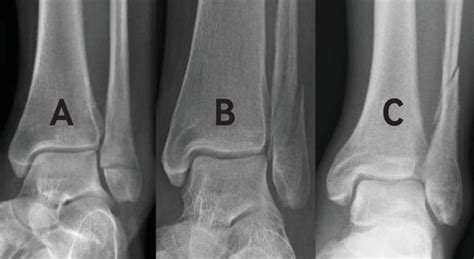 Three week versus six week immobilisation for stable Weber B type ankle ...