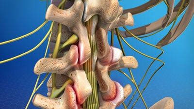 Laminectomy. Potential complications from surgery… | by Pain Management ...