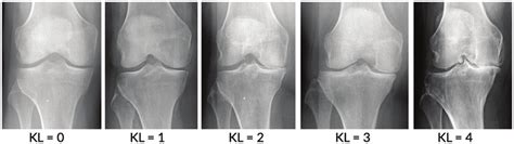 Stage of knee osteoarthritis [7] | Download Scientific Diagram