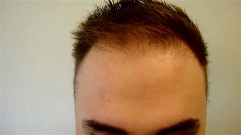 Fixing a bad hair transplant result - YouTube