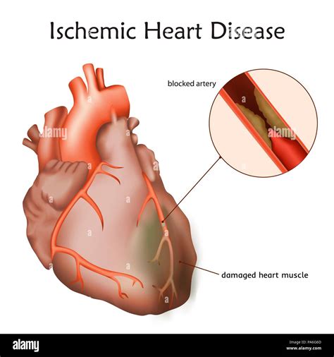 Ischemic heart disease, illustration. A blocked coronary artery has led to heart muscle damage ...