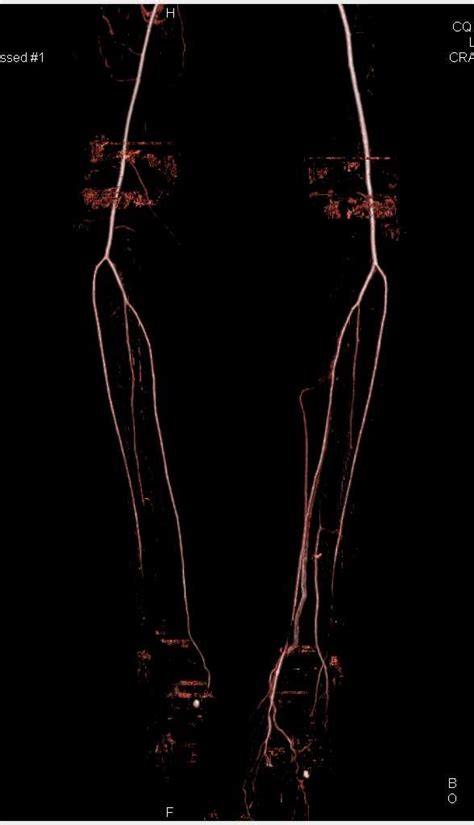 High Grade Stenosis Right Femoral Artery - Vascular Case Studies ...