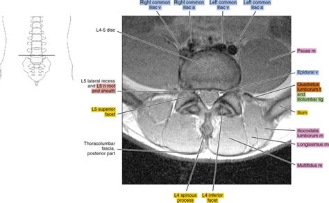 Lumbar Spine Mri Labeled