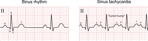 Sinus Tachycardia