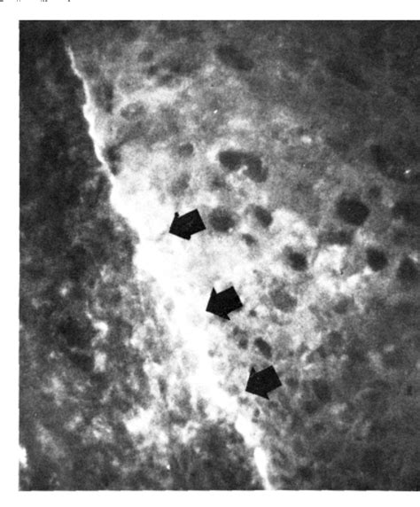 Figure 3 from Benign Mucous Membrane Pemphigoid | Semantic Scholar