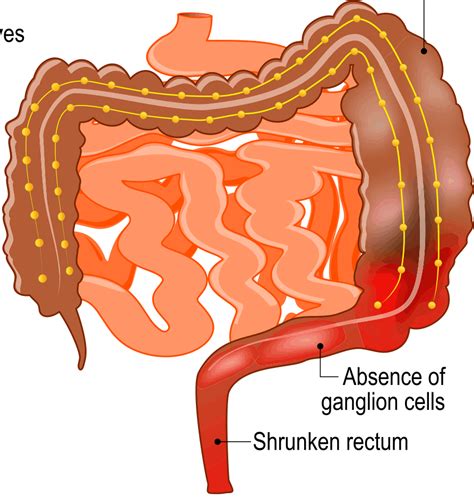 Hirschsprung's disease - Pathophysiology - TeachMePaediatrics