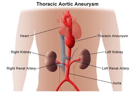 Aorta, thoracic; Aorta, Descending; Aortic Arch; Arch of the Aorta